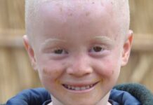 Madagascar : les personnes atteintes d’albinisme sont les cibles de fréquentes attaques, alertent des experts