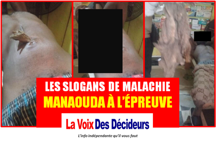 Négligence médicale présumée au Centre des Urgences de Yaoundé – CURY : De graves accusations d’une famille relancent le débat sur l’humanisation des soins au Cameroun, Malachie Manaouda « indifférent »